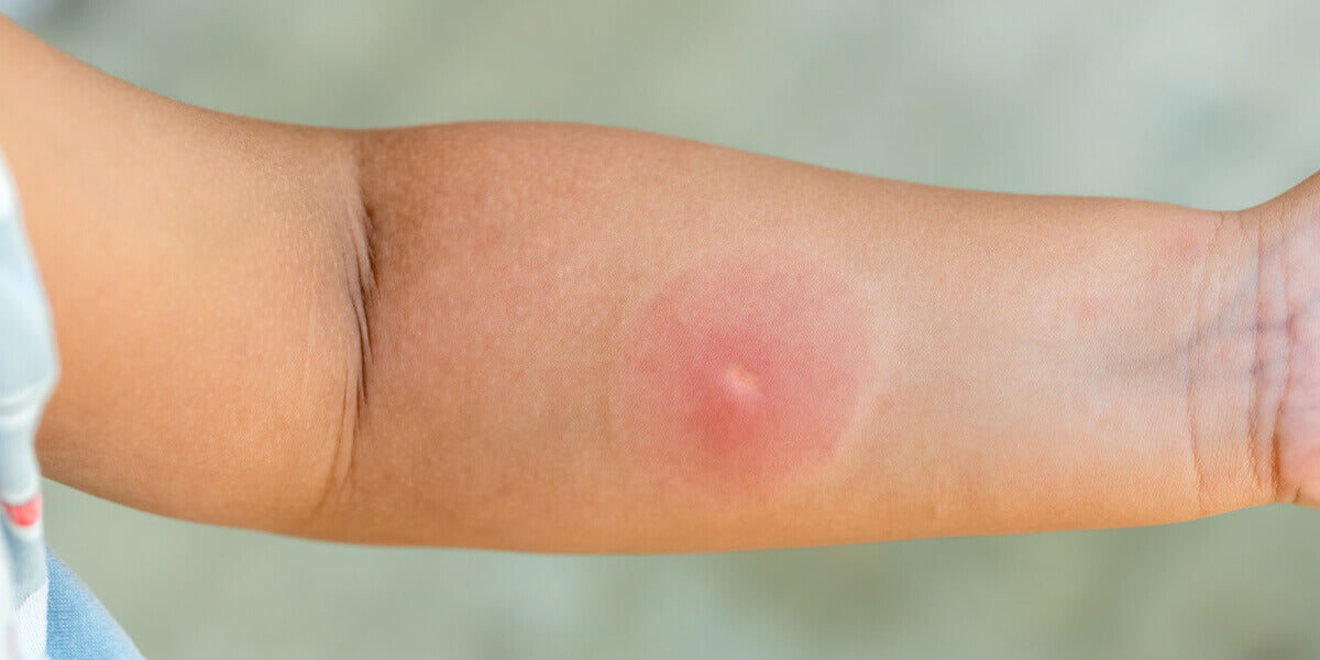 Wespenstich am Arm