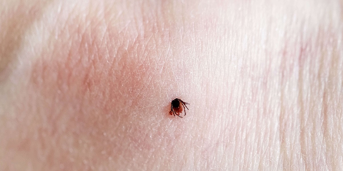 Zeckenbiss